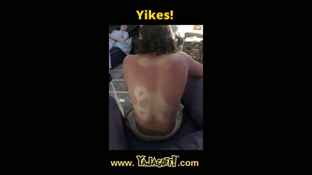 YaJagoff.com sunburn